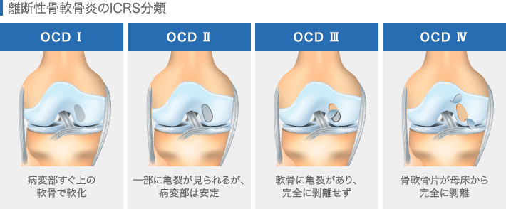 離断性軟骨炎のICRS分類