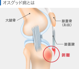 オスグッド病の関節図