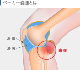 ベーカー嚢腫ができる位置