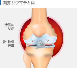 関節リウマチの膝