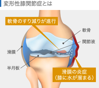 変形性膝関節症の関節図