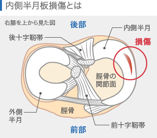 内側半月板損傷