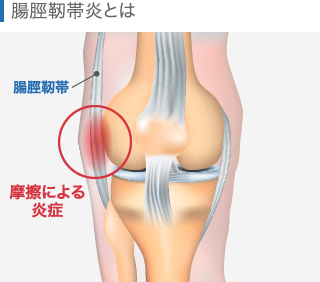 腸脛靭帯炎（ランナー膝）の関節図