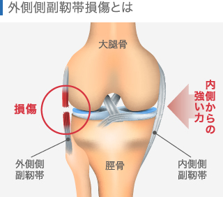 外側側副靭帯損傷の関節図