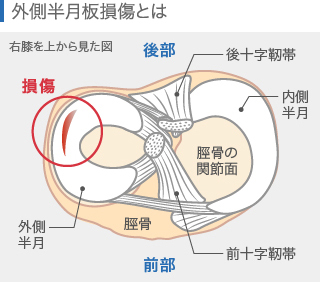 外側半月板損傷