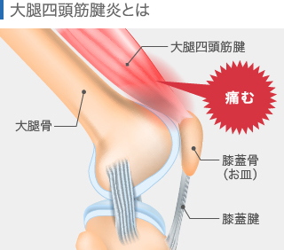 大腿四頭筋腱炎（ジャンパー膝）