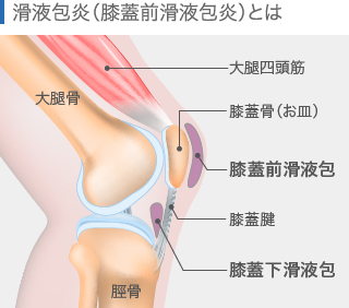 滑液包炎（膝蓋前滑液包炎）