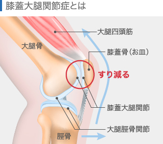 膝蓋大腿関節症
