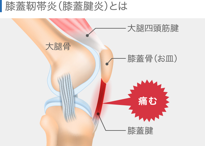 膝の痛みの原因を場所別に解説 内側 外側 膝上 膝下 ひざ裏 膝の痛みの原因を場所別に解説 内側 外側 膝上 膝下 ひざ裏