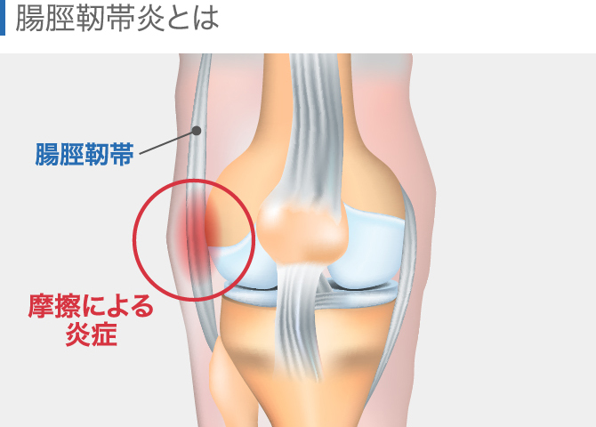 膝の痛みの原因を場所別に解説 内側 外側 膝上 膝下 ひざ裏 膝の痛みの原因を場所別に解説 内側 外側 膝上 膝下 ひざ裏