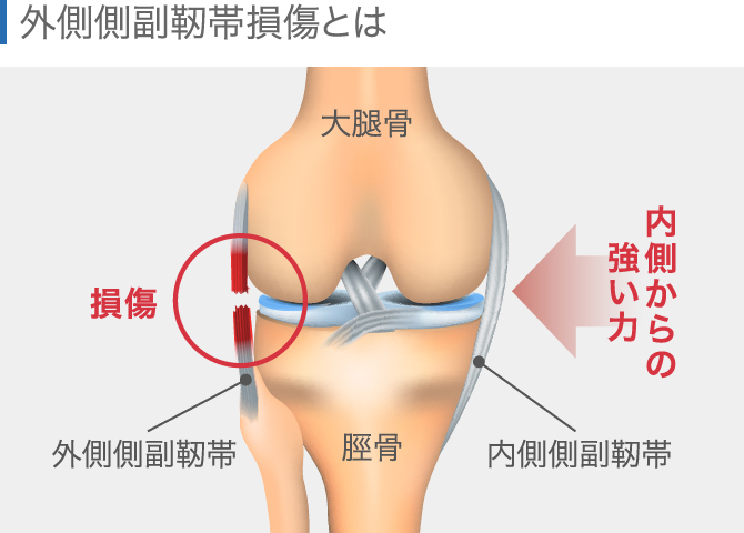 膝の痛みの原因を場所別に解説 内側 外側 膝上 膝下 ひざ裏