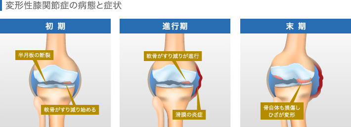 変形膝関節症の進行と関節内の状態