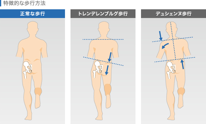 変形性膝関節症の特徴的な歩行と正常な歩行との違い