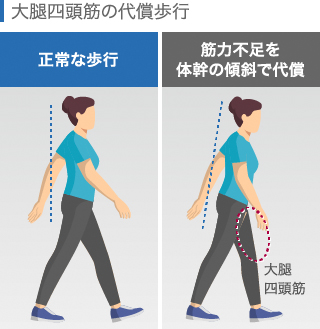 大腿四頭筋の筋力不足を補う場合の歩行の特徴