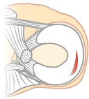 半月板の縦断裂