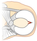 半月板の横断裂