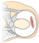 半月板の水平断裂