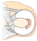 半月板の変性断裂