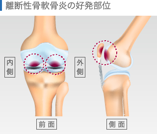 離断性骨軟骨炎の好発部位