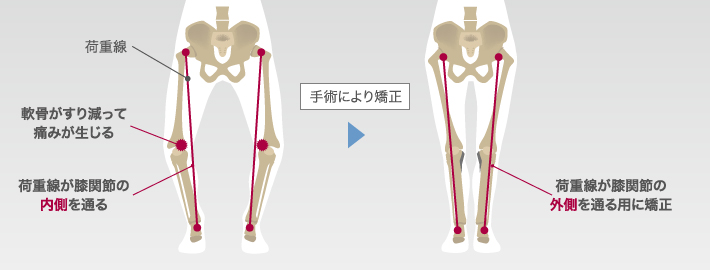 高位脛骨骨切り術