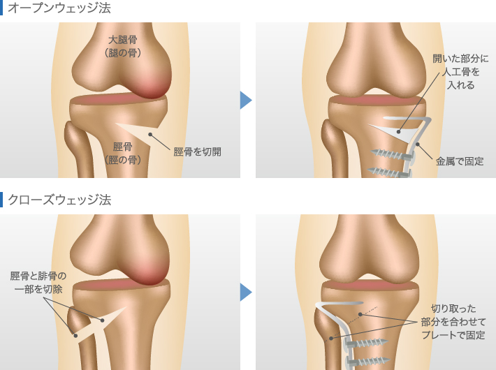 オープンウェッジ法とクローズウェッジ法