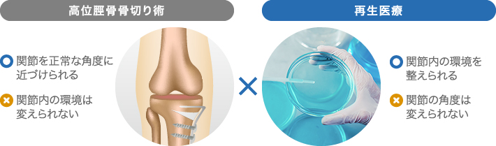 高位脛骨骨切り術と再生医療の併用