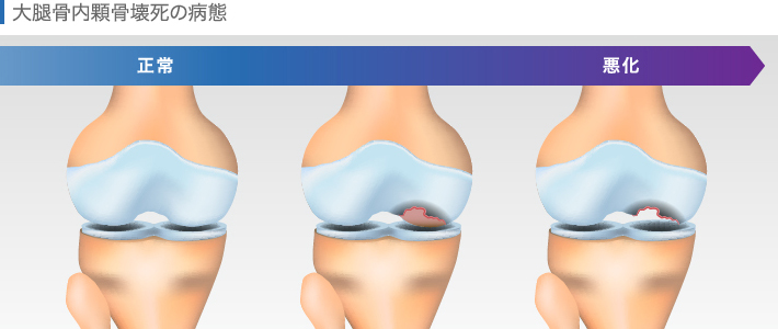 大腿骨内顆骨壊死の進行イメージ