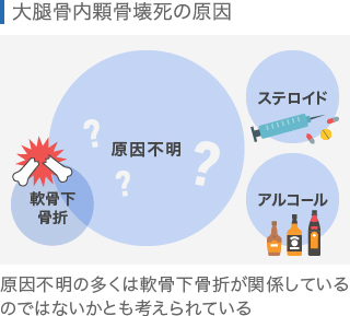 大腿骨内顆骨壊死(膝の骨壊死）の原因