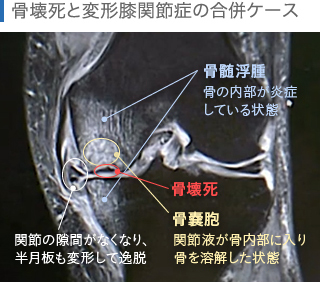 骨壊死と変形性膝関節症を合併したケースのMRI画像