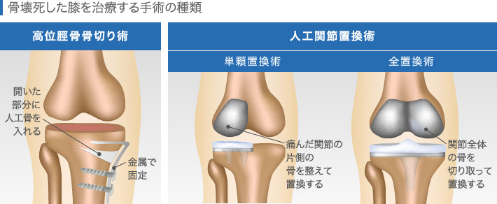 骨壊死した膝を治療する手術の種類