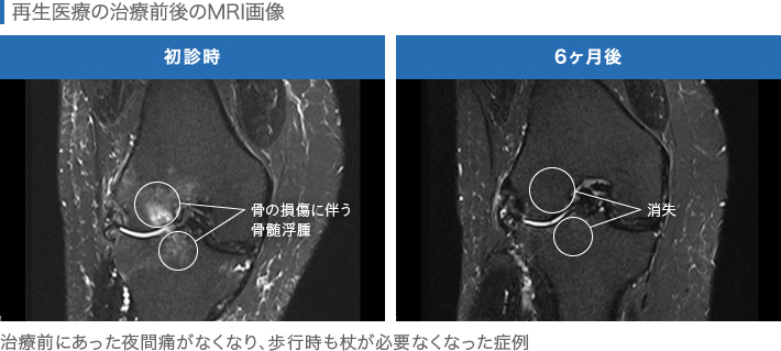 再生医療の治療前後の膝MRI画像