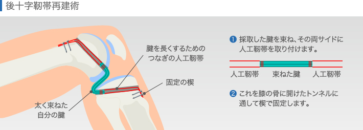 後十字靭帯再建術の方法