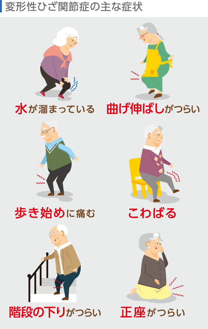 変形性膝関節症の主な症状