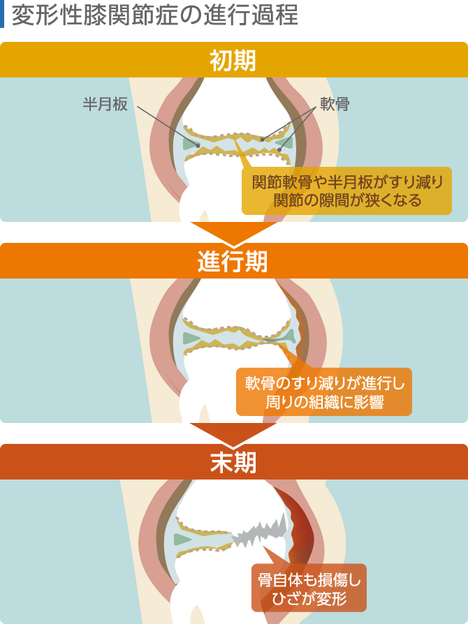 変形性膝関節症の進行過程