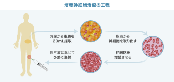 培養幹細胞治療の工程