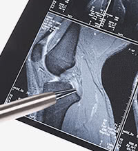 ひざ関節のMRI画像とボールペン