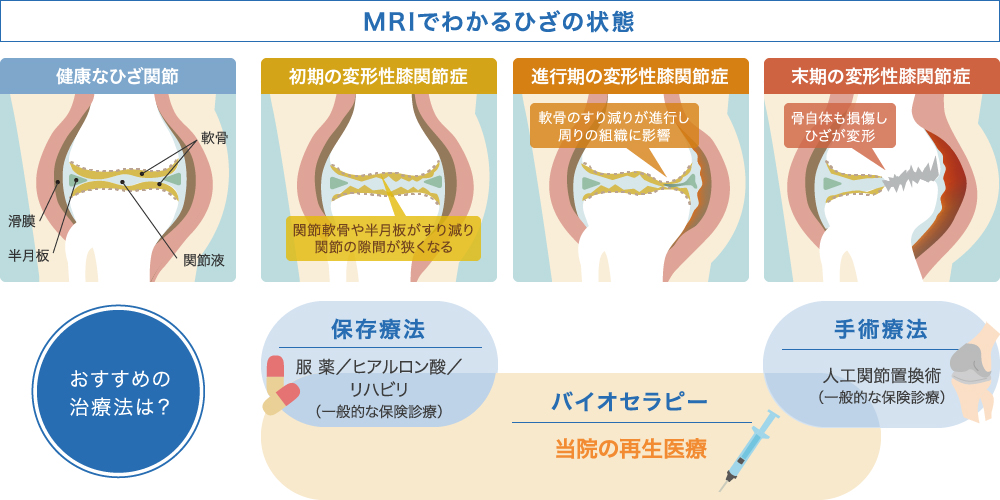MRIでわかるひざの状態とおすすめの施術法