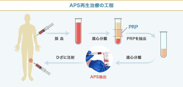 APS療法の工程