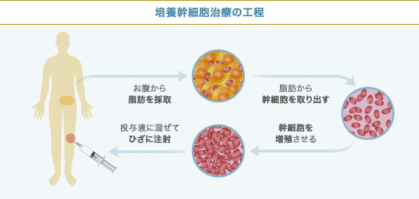 培養幹細胞治療の工程