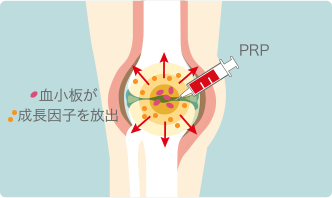 PRP療法とは