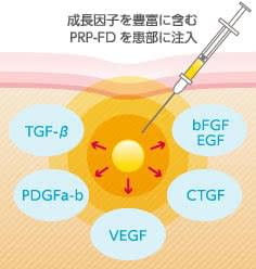 PRP-FD注射に含まれる成長因子の種類