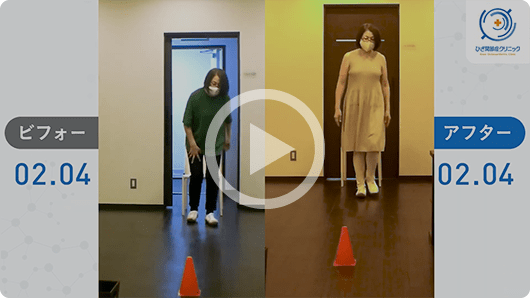 患者様の治療前後の歩行比較動画２