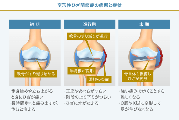 変形性膝関節症とは？【痛みの原因／症状／治療法】｜ひざ関節症クリニック