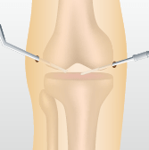 変形性膝関節症の代表的な３つの手術 関節鏡視下手術