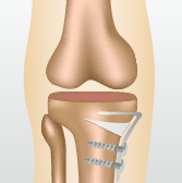 変形性膝関節症の代表的な３つの手術 高位脛骨骨切り術