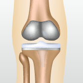 変形性膝関節症の代表的な３つの手術 人工関節置換術